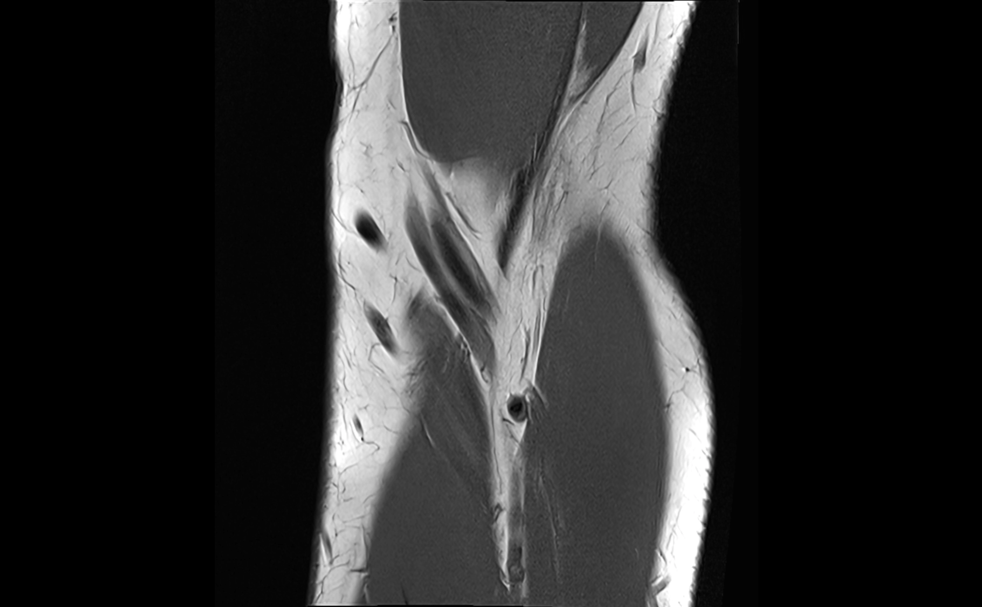 MRI elbow ligaments coronal cross sectional anatomy 3T  radiology  image-img-07001-00007.webp